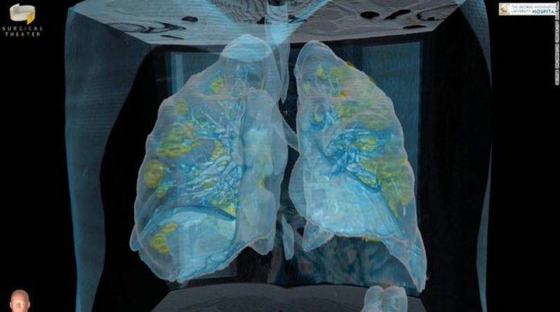 Как коронавирус действует на легкие при бессимптомном течении болезни, показали врачи (видео) - usa.one - Сша