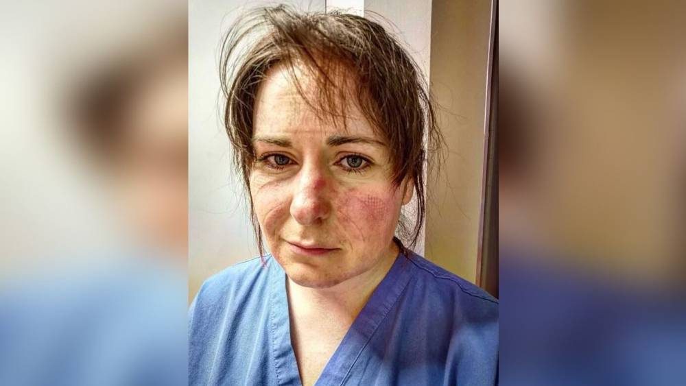 Медсестра из Британии показала лицо после 13-часовой смены в защитном костюме - politexpert.net - Англия
