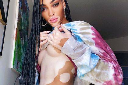 Супермодель с заболеванием кожи снялась топлес в изоляции - lenta.ru