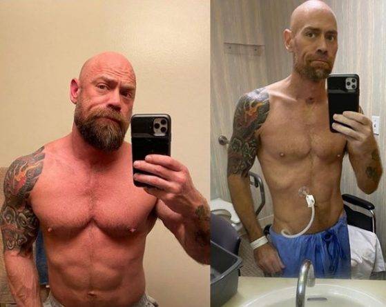 Майк Шульц - Выживший после коронавируса мужчина поделился шокирующими фото изменений своего тела - usa.one - Сан-Франциско - штат Калифорния