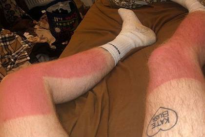 Солнечные ожоги странной формы на ногах мужчины подняли на смех в сети - lenta.ru - Англия
