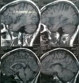 О риске попадания COVID-19 в мозг через нос предупредили немецкие учёные - ufacitynews.ru - Германия