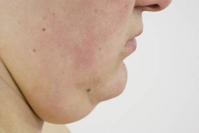 Избавление от второго подбородка стало трендом после карантина - lenta.ru - Лондон