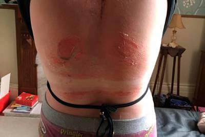 Волдыри на спине девушки после пляжного отдыха перепугали пользователей сети - lenta.ru - Англия - Куба
