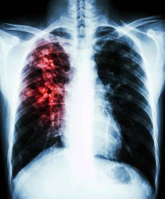От туберкулеза ежегодно умирает столько же людей, сколько от COVID-19 - live24.ru - Москва
