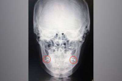 Подмосковные врачи помогли пациентке с неправильно установленным пирсингом - m24.ru