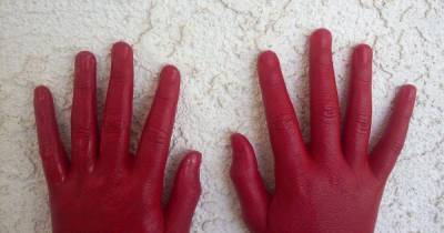 Красные руки назвали симптомом опасной болезни печени - ren.tv