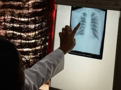 ВОЗ: смертность от туберкулеза в мире выросла впервые за десятилетие - unn.com.ua - Украина - Киев
