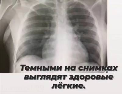 Главврач нижегородской больницы наглядно показала, чем опасен COVID-19 для легких - vgoroden.ru - Нижний Новгород