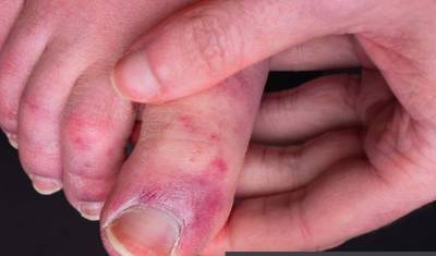 Врачи в Британии заявили, что обморожение пальцев похоже на ещё один симптом COVID - newizv.ru - Англия