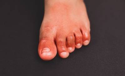 Ученые обнаружили новый симптом COVID, напоминающий обморожения ног (фото) - narodna-pravda.ua - Украина