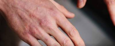 Ложное обморожение пальцев внесли в перечень симптомов кожного проявления COVID-19 - runews24.ru
