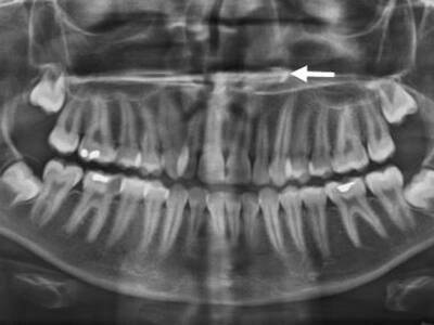 Не проходит насморк? Проверьте, нет ли в носу зуба - bloknot.ru