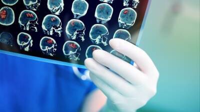 Невролог рассказал о четырех признаках инсульта - 5-tv.ru - Москва