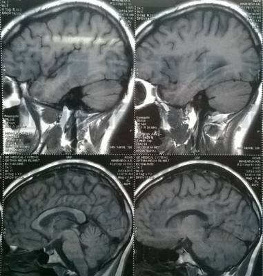 Американские ученые опровергли вероятность поражения мозга коронавирусом - ufacitynews.ru - Колумбия