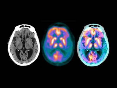 Исследование: COVID-19 может привести к деменции, подобной болезни Альцгеймера - unn.com.ua - Киев
