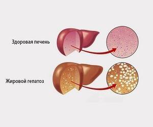 Ключ к здоровью печени - goodnews.ua