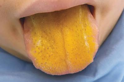 Редкое заболевание окрасило язык мальчика в ярко-желтый цвет - lenta.ru - Англия - Канада - Торонто - провинция Онтарио