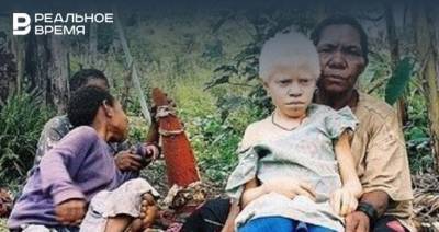 ООН сообщила о росте количества убийств людей с альбинизмом из-за пандемии - realnoevremya.ru
