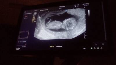 COVID-19 связан с осложнениями во время беременности - ufacitynews.ru - Шотландия