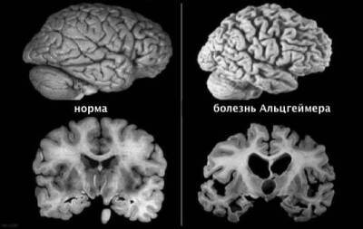 У перенёсших COVID-19 нашли изменения в мозге по типу болезни Альцгеймера - govoritmoskva.ru - Сша - Колумбия
