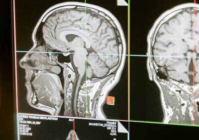 Ученые выявили у умерших от COVID-19 изменения в мозге как при болезни Альцгеймера - ya62.ru - Колумбия