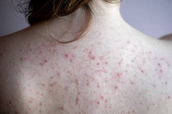 Врачи назвали шесть кожных симптомов коронавируса - vologda-poisk.ru
