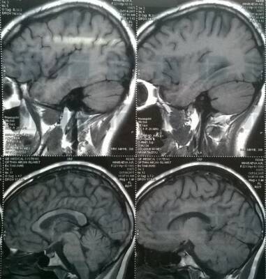Ковид вызывает уменьшение объема мозга, предупредили британские ученые - ufacitynews.ru