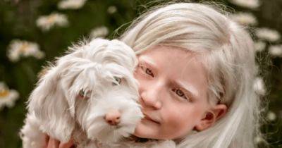 Как живет уникальная девочка-альбинос с чрезмерно подвижными глазами (фото, видео) - focus.ua - Украина - Сша