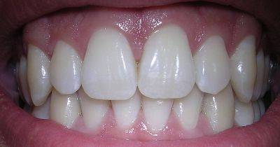 Стоматологи рекомендуют: эти продукты сохранят здоровье зубов - dsnews.ua