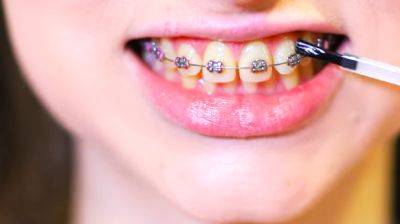 Есть заболевания, при которых лучше не рисковать выравнивать зубы: стоматолог рассказал, кому нельзя ставить брекеты - ukrainianwall.com - Украина