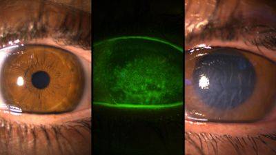 Врач предупреждает: цветные контактные линзы могут привести к слепоте - vesty.co.il - Израиль