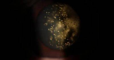В глазах зажигается целая галактика: названа самая "красивая" болезнь (видео) - focus.ua - Украина